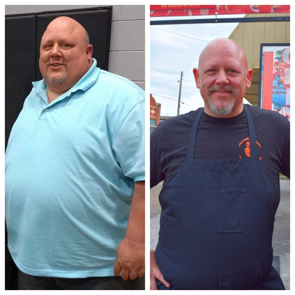 Dougherty before and after bariatric surgery