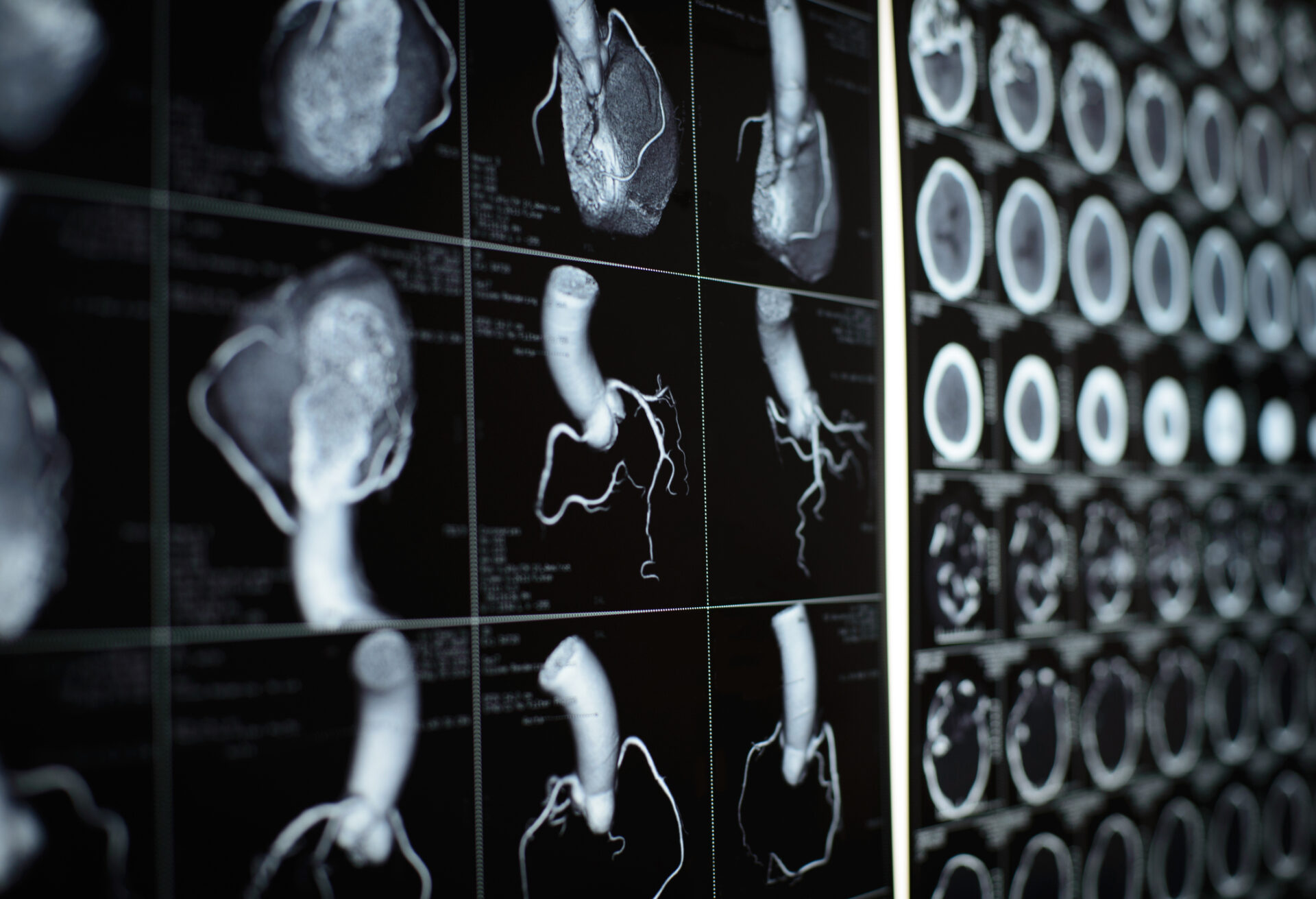 Human heart and coronary artery CT images on black film.